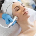Key Benefits of Microdermabrasion